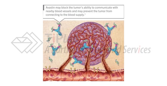 Avastin®的作用原理，图片来源：基因泰克