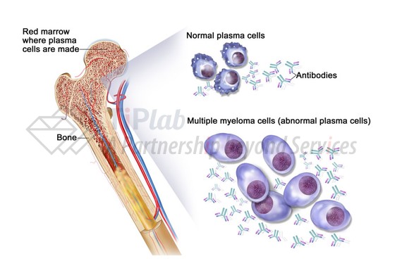 参见:Multiple myeloma: Cancer in plasma cells